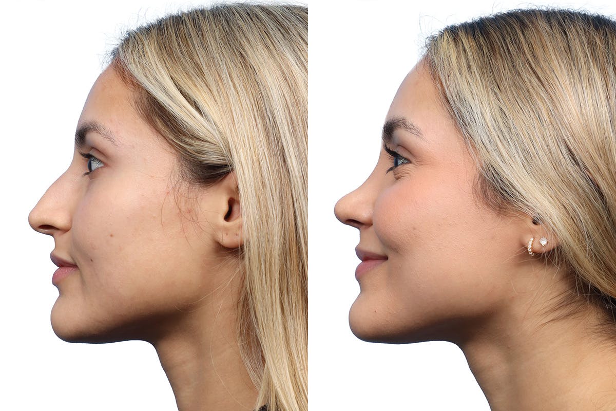 Rhinoplasty Before & After Gallery - Patient 252896 - Image 2