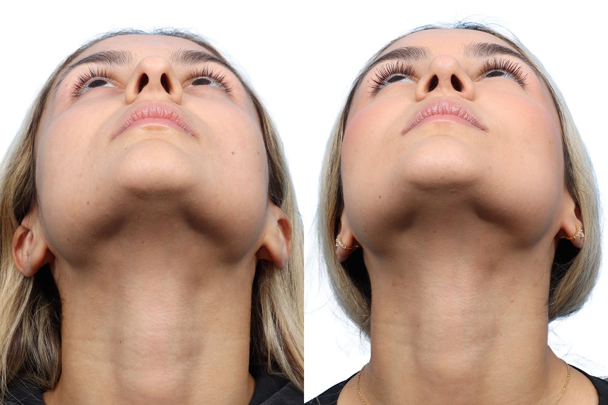 Rhinoplasty Before & After Gallery - Patient 252896 - Image 4