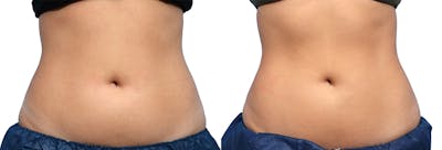 CoolSculpting® Before & After Gallery - Patient 729789 - Image 1