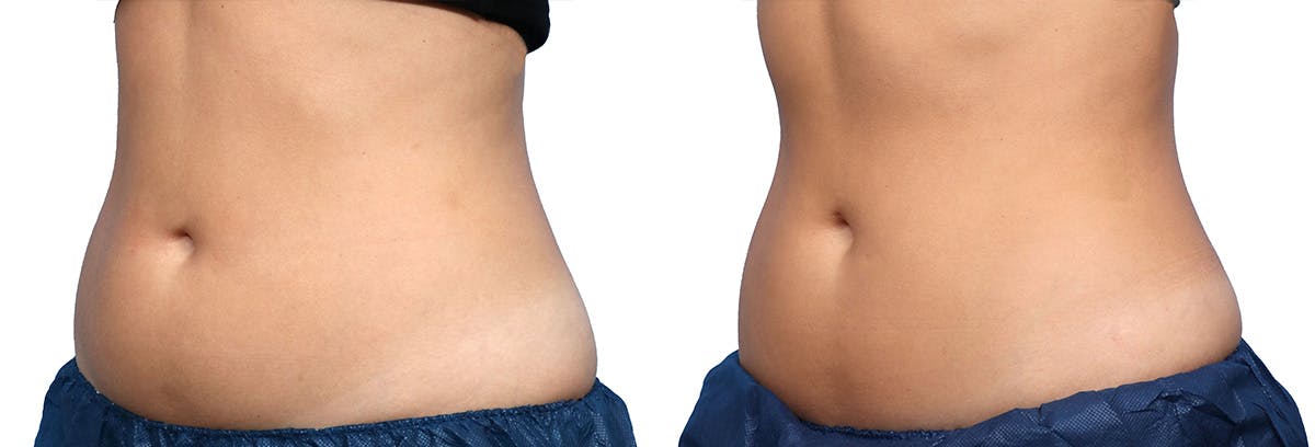 CoolSculpting® Before & After Gallery - Patient 729789 - Image 2