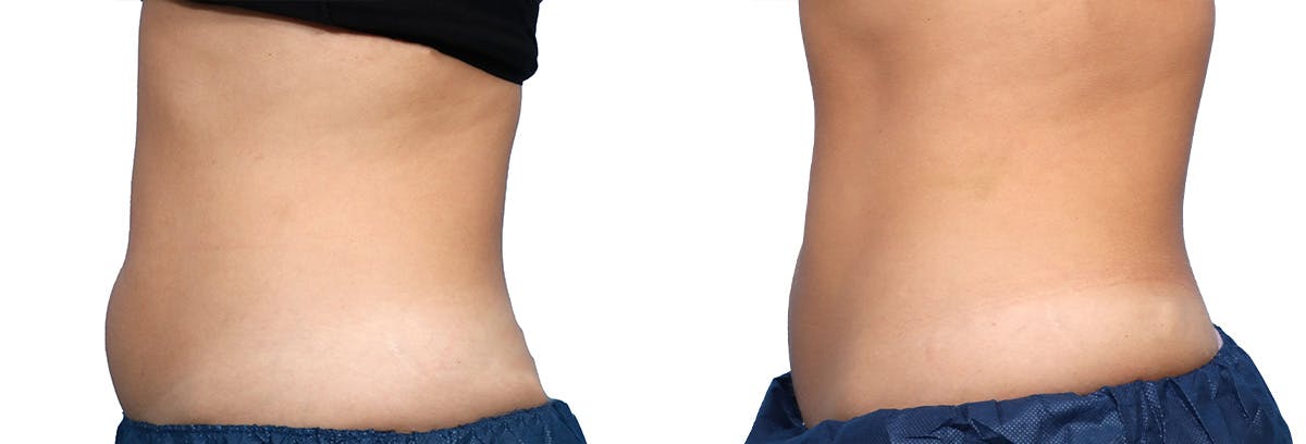 CoolSculpting® Before & After Gallery - Patient 729789 - Image 3