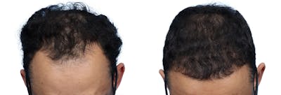 FUE Hair Transplant Before & After Gallery - Patient 200610 - Image 1