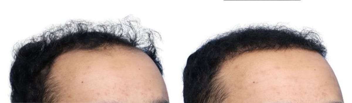 FUE Hair Transplant Before & After Gallery - Patient 200610 - Image 3