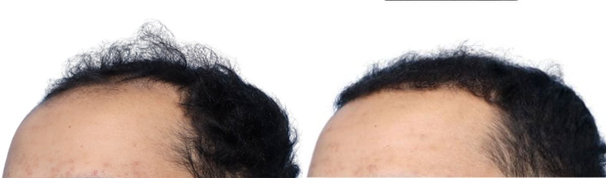FUE Hair Transplant Before & After Gallery - Patient 200610 - Image 2