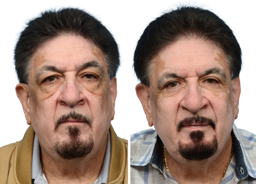 Blepharoplasty (Eyelid Surgery) Before & After Gallery - Patient 124809 - Image 1