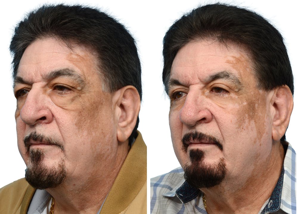 Blepharoplasty (Eyelid Surgery) Before & After Gallery - Patient 124809 - Image 2