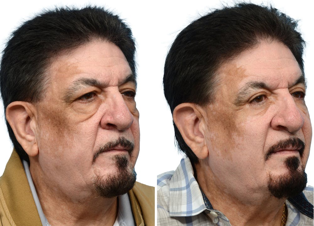 Blepharoplasty (Eyelid Surgery) Before & After Gallery - Patient 124809 - Image 3