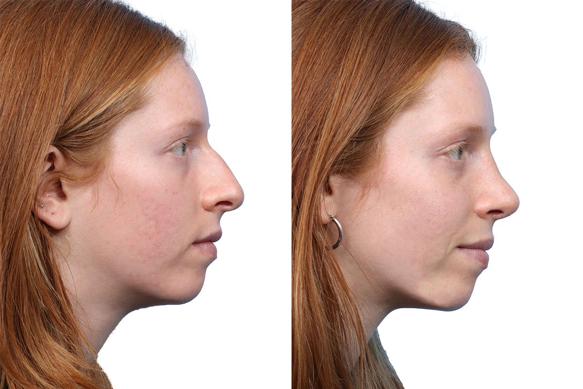 Rhinoplasty Before & After Gallery - Patient 310368 - Image 1