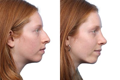 Rhinoplasty Before & After Gallery - Patient 310368 - Image 1
