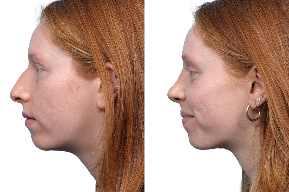 Rhinoplasty Before & After Gallery - Patient 310368 - Image 2