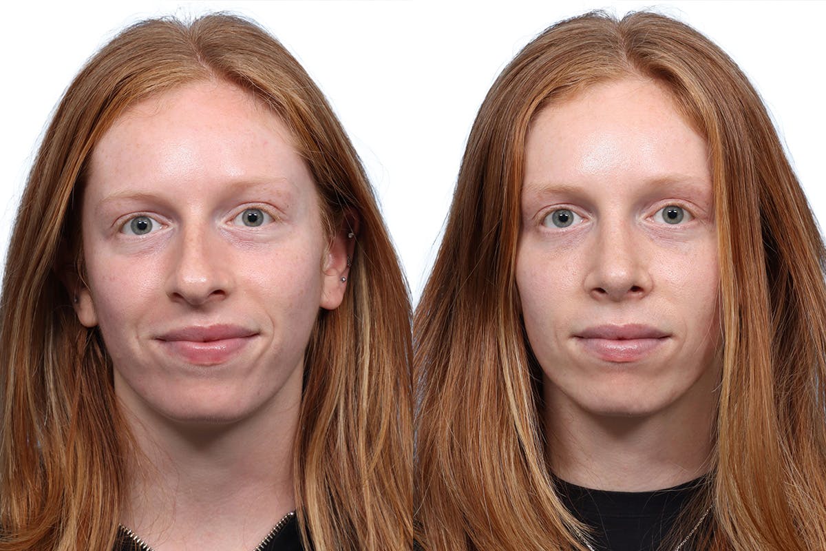 Rhinoplasty Before & After Gallery - Patient 310368 - Image 3