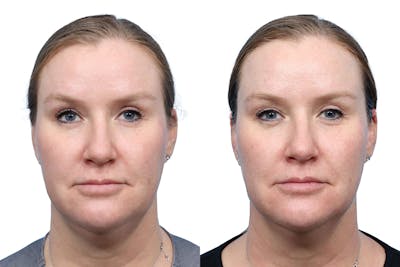 Glacial Skin Rx  Before & After Gallery - Patient 354819 - Image 1