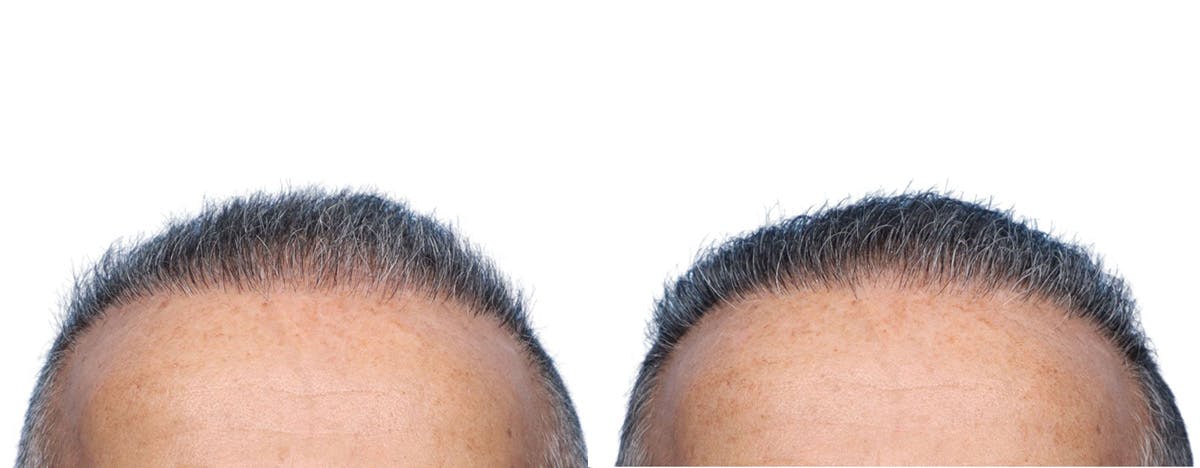 FUE Hair Transplant Before & After Gallery - Patient 149593 - Image 2