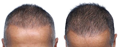 FUE Hair Transplant Before & After Gallery - Patient 149593 - Image 1