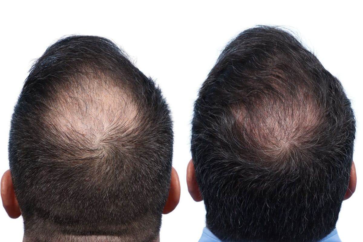 FUE Hair Transplant Before & After Gallery - Patient 139473 - Image 2