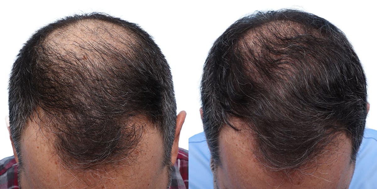 FUE Hair Transplant Before & After Gallery - Patient 139473 - Image 1