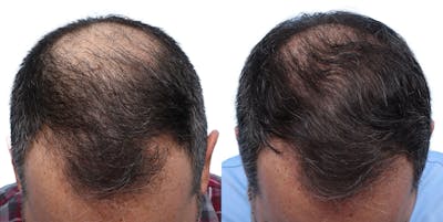 FUE Hair Transplant Before & After Gallery - Patient 139473 - Image 1