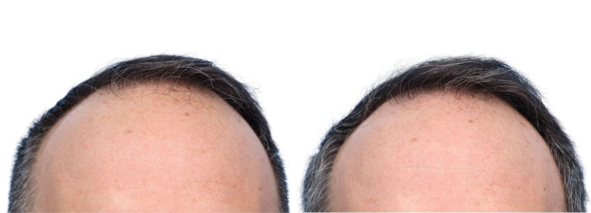 FUE Hair Transplant Before & After Gallery - Patient 139473 - Image 3