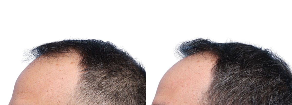 FUE Hair Transplant Before & After Gallery - Patient 139473 - Image 5