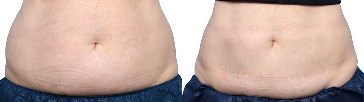 CoolSculpting® Before & After Gallery - Patient 240252 - Image 1