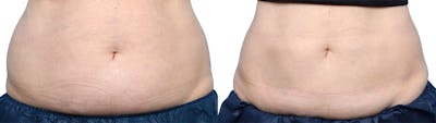 CoolSculpting® Before & After Gallery - Patient 240252 - Image 1