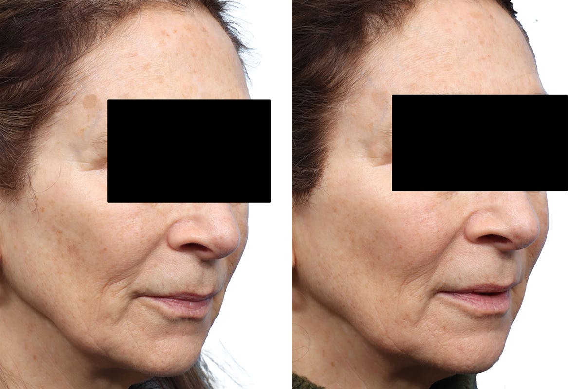 Lutronic Ultra Before & After Gallery - Patient 211242 - Image 1