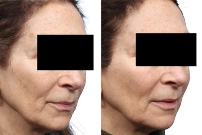 Lutronic Ultra Before & After Gallery - Patient 211242 - Image 1
