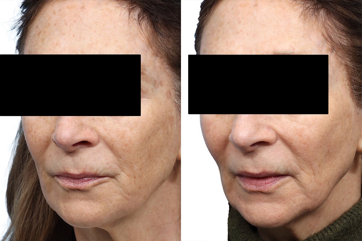 Lutronic Ultra Before & After Gallery - Patient 211242 - Image 2