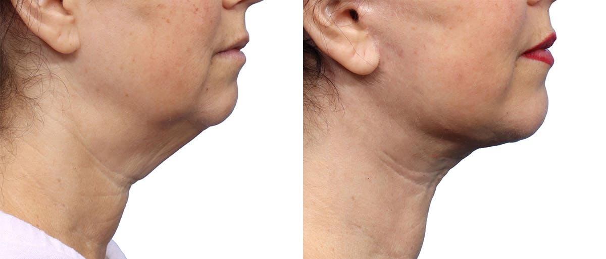 Deep Plane Facelift Before & After Gallery - Patient 367208 - Image 2