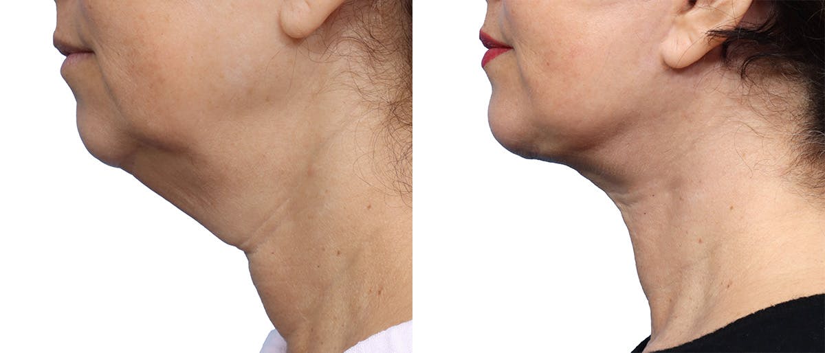 Deep Plane Facelift Before & After Gallery - Patient 367208 - Image 3