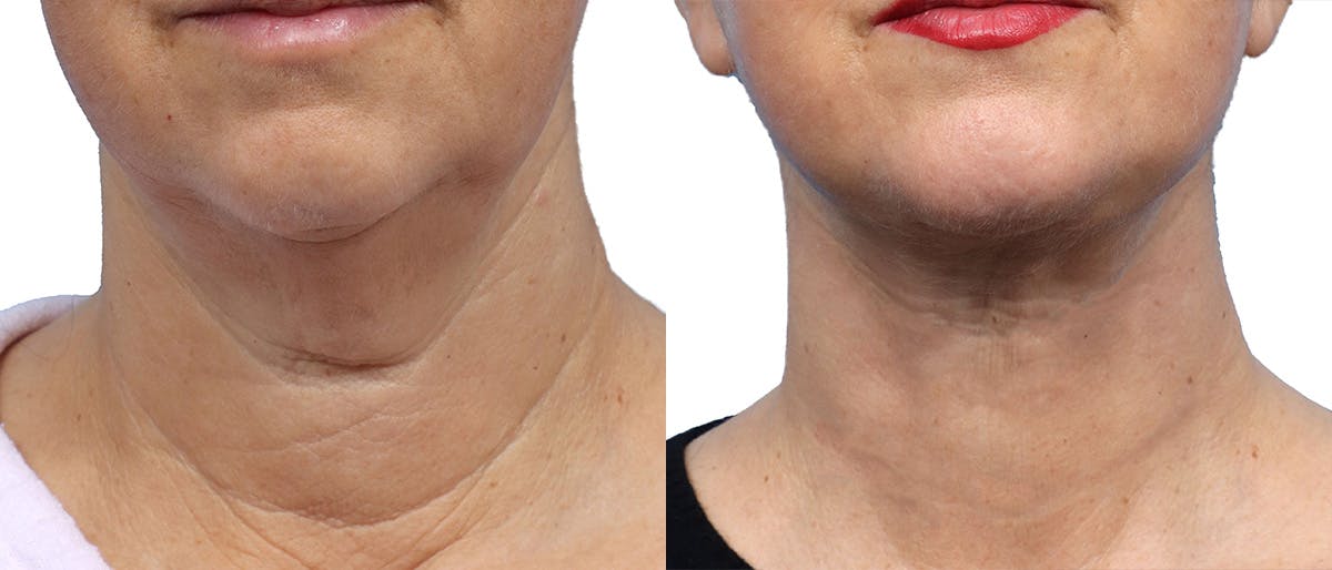 Deep Plane Facelift Before & After Gallery - Patient 367208 - Image 1