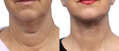 Deep Plane Facelift Before & After Gallery - Patient 367208 - Image 1