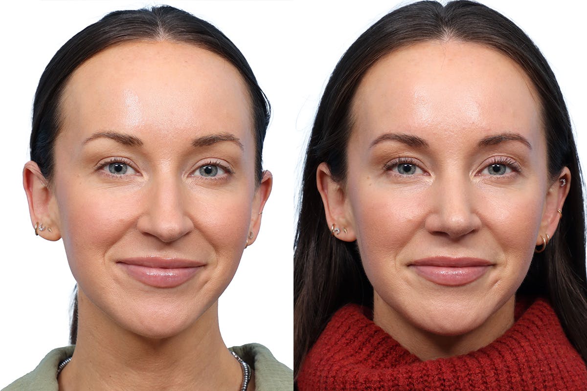 Rhinoplasty Before & After Gallery - Patient 264813 - Image 3