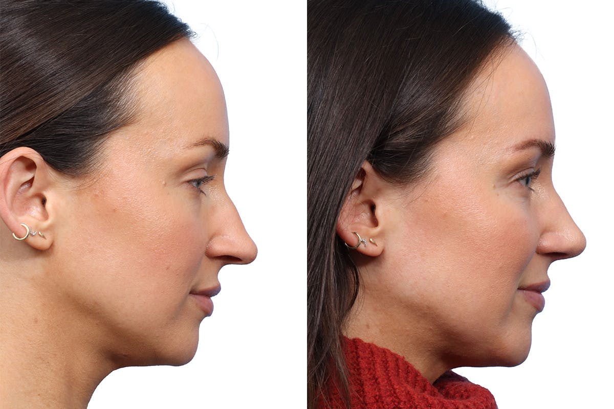 Rhinoplasty Before & After Gallery - Patient 264813 - Image 1