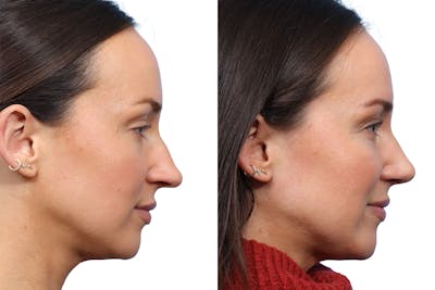 Rhinoplasty Before & After Gallery - Patient 264813 - Image 1