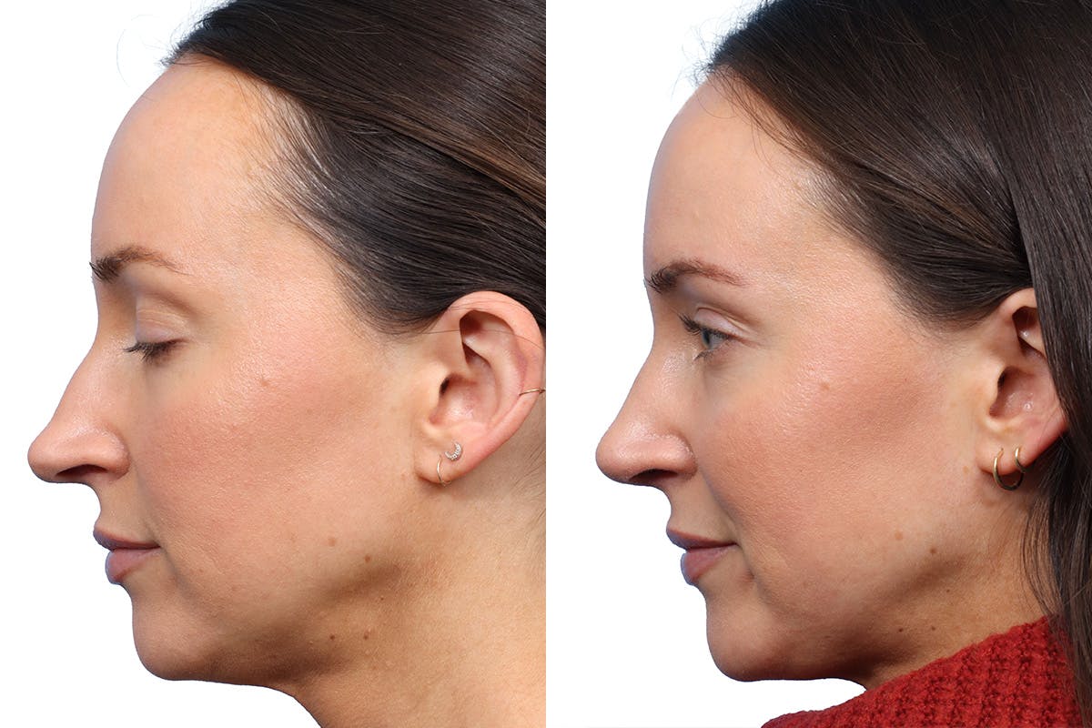 Rhinoplasty Before & After Gallery - Patient 264813 - Image 2