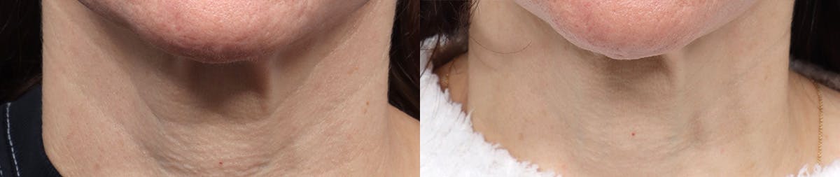 Morpheus8® Before & After Gallery - Patient 410976 - Image 1