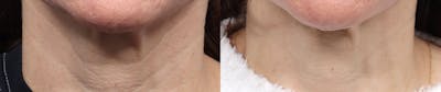 Morpheus8® Before & After Gallery - Patient 410976 - Image 1