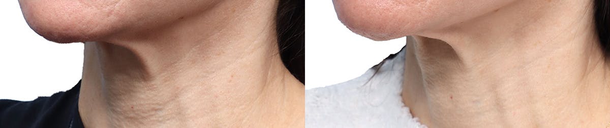 Morpheus8® Before & After Gallery - Patient 410976 - Image 3