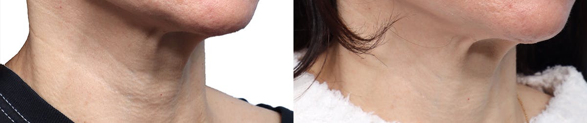 Morpheus8® Before & After Gallery - Patient 410976 - Image 2
