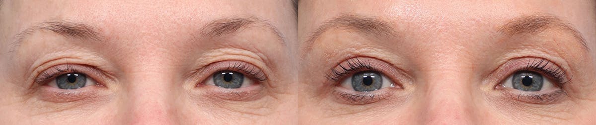 Blepharoplasty (Eyelid Surgery) Before & After Gallery - Patient 189343 - Image 1