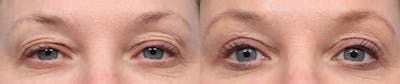 Blepharoplasty (Eyelid Surgery) Before & After Gallery - Patient 189343 - Image 1
