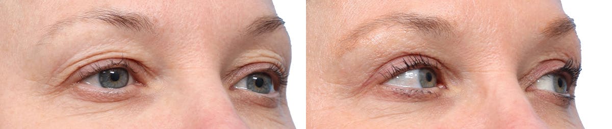 Blepharoplasty (Eyelid Surgery) Before & After Gallery - Patient 189343 - Image 2