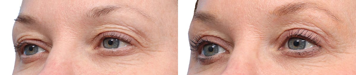 Blepharoplasty (Eyelid Surgery) Before & After Gallery - Patient 189343 - Image 3