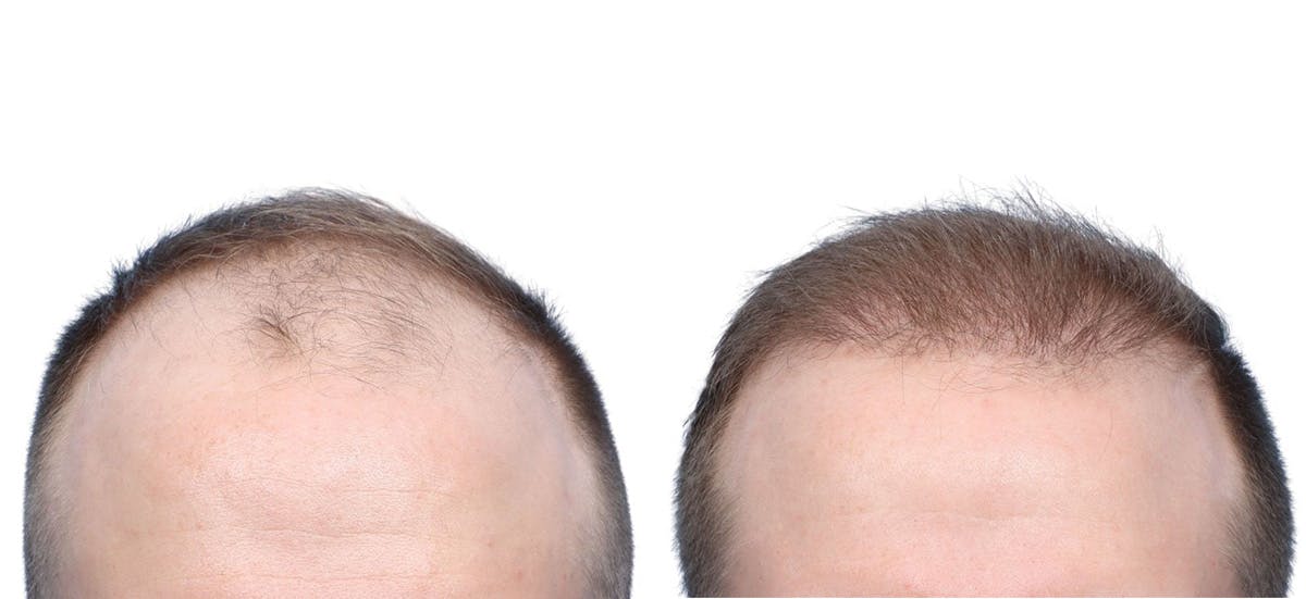 FUE Hair Transplant Before & After Gallery - Patient 331946 - Image 2