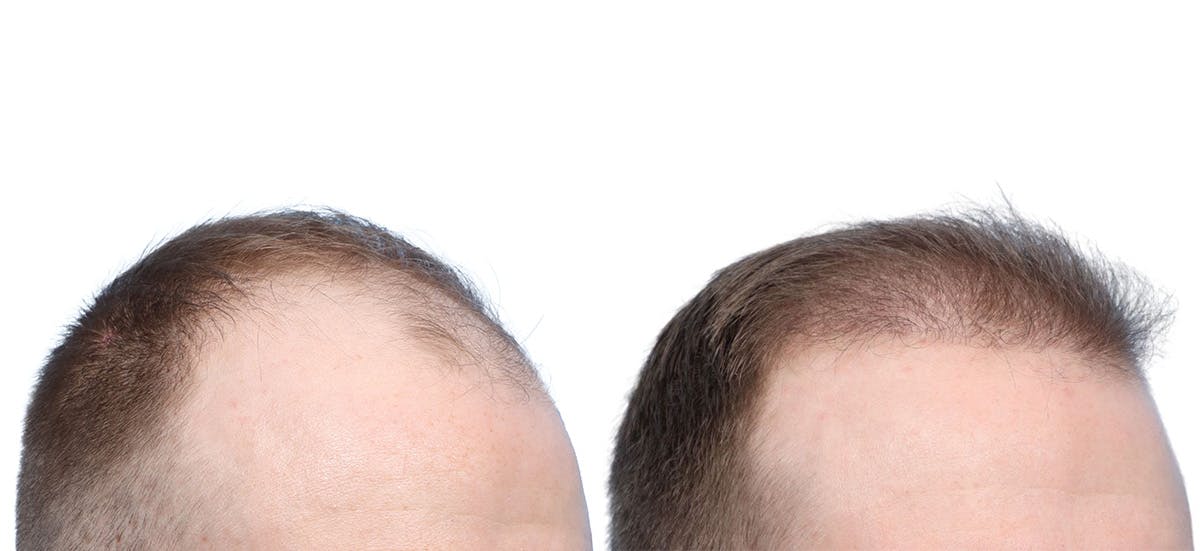 FUE Hair Transplant Before & After Gallery - Patient 331946 - Image 3