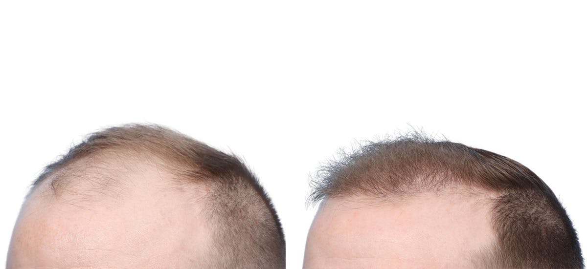 FUE Hair Transplant Before & After Gallery - Patient 331946 - Image 4