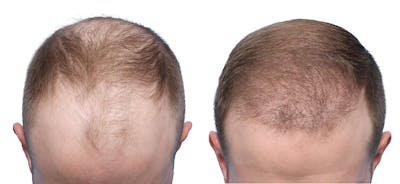 FUE Hair Transplant Before & After Gallery - Patient 331946 - Image 1