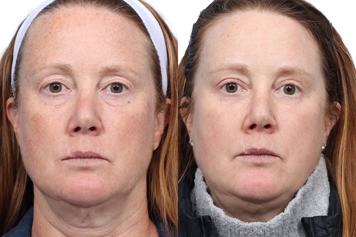 Blepharoplasty (Eyelid Surgery) Before & After Gallery - Patient 120652 - Image 1