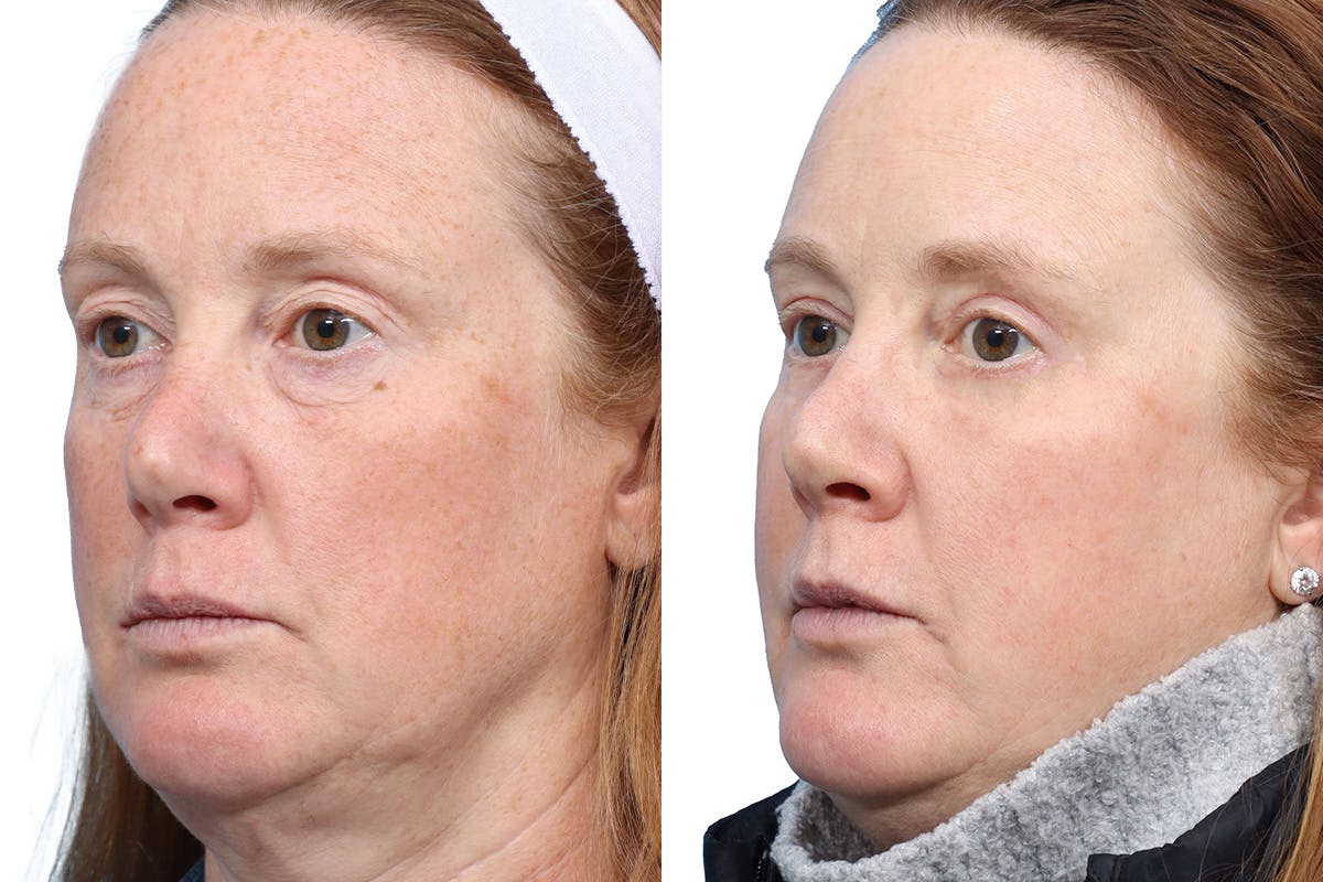 Blepharoplasty (Eyelid Surgery) Before & After Gallery - Patient 120652 - Image 3